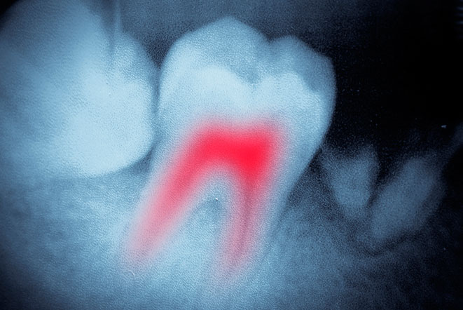 Депульпирование: как и в какую сторону изменяется зуб?