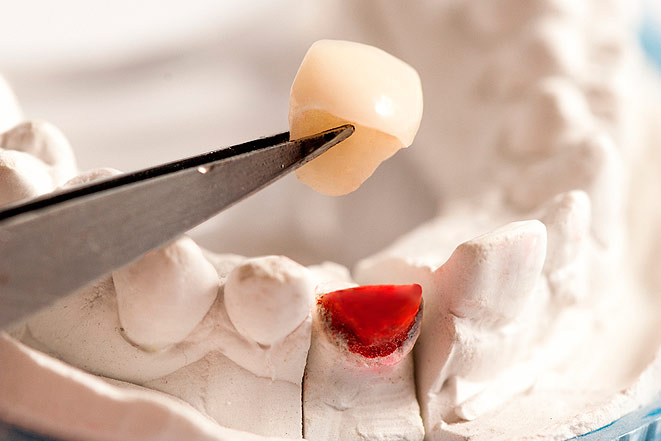 Виды и показания к протезированию зубов коронками