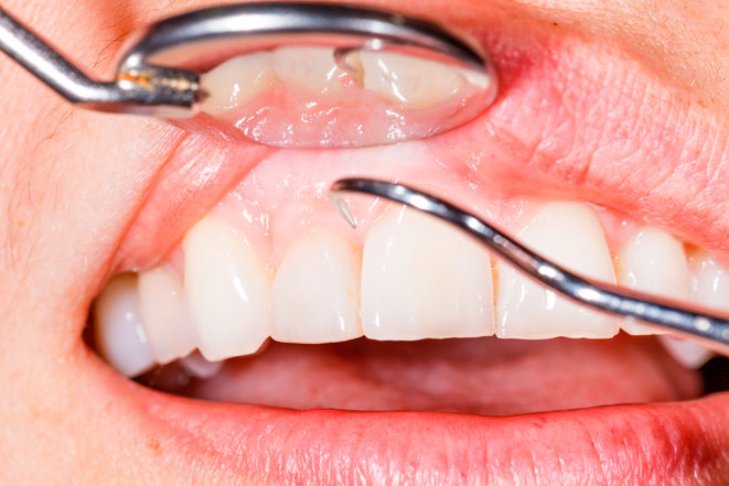 Читаем симптом:  десны отходят от зубов