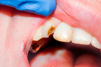 Реставрация зубов изображение 3