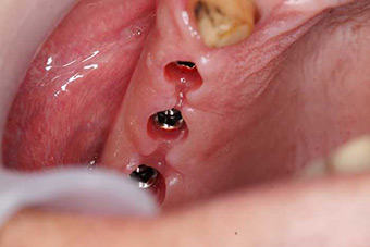 Имплантация зубов изображение 4