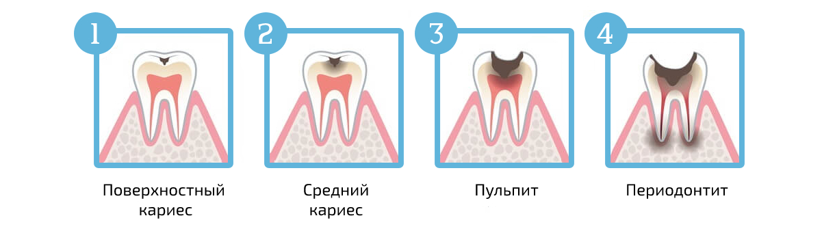 det_periodontit.jpg