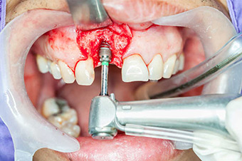 Имплантация зубов изображение 3