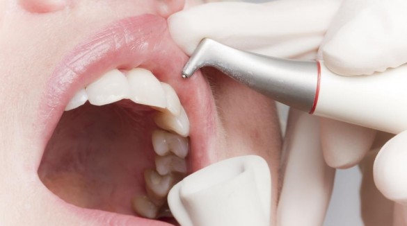 Стоматологическое отбеливание зубов Эир-Флоу