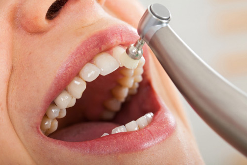 Механическое зубное отбеливание