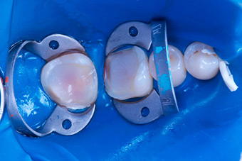 Реставрация зубов изображение 2