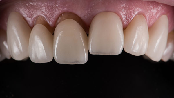 Временные коронки при протезировании зубов