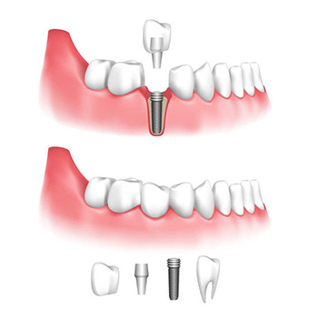 Имплантация зубов изображение 2
