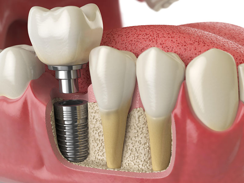 Выпадают ли импланты зубов?