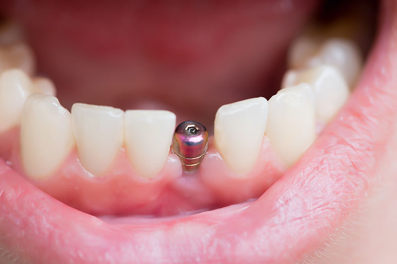 Что делать если выпал имплант зуба?