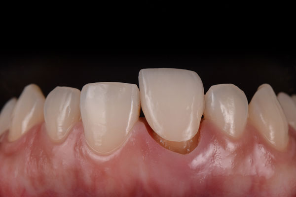 Временные коронки при протезировании зубов