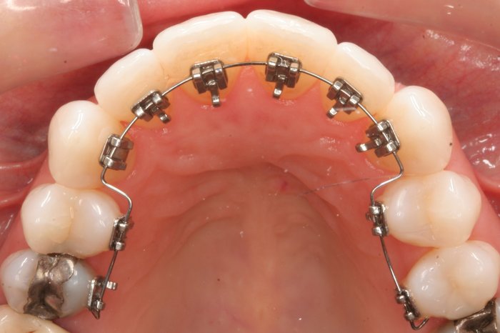 Лингвальные брекеты устанавливаются с внутренней стороны зубного ряда, а потому полностью незаметны