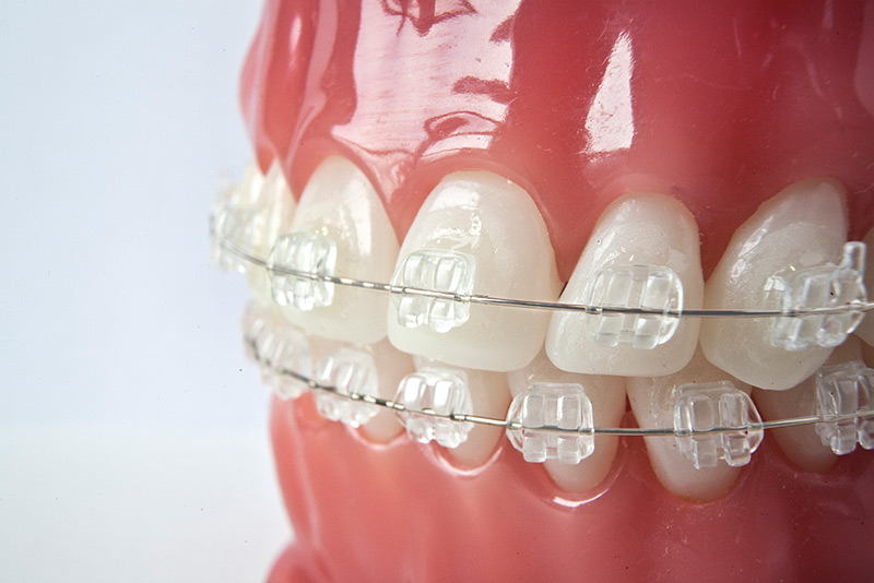 Керамические прозрачные или сапфировые брекеты на зубах почти незаметны
