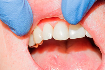 Реставрация зубов изображение 5