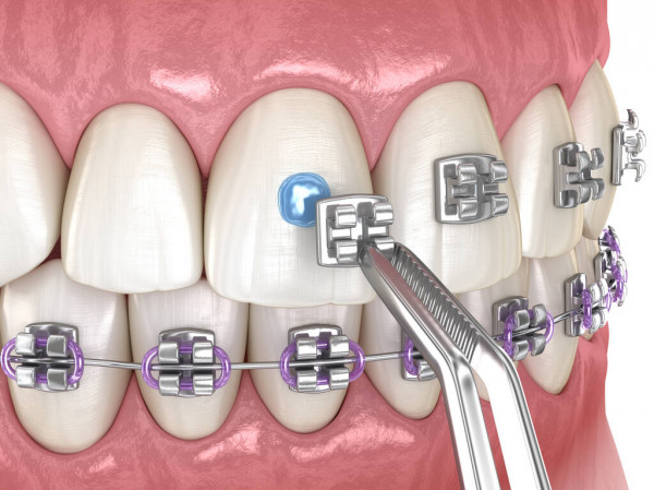 Металлические брекеты – классические системы, хотя и очень заметны на зубах, но достаточно функциональны, доступны по цене и при этом эффективны.