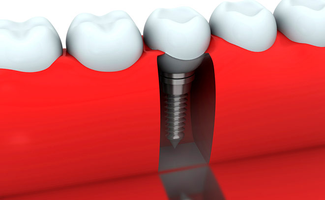 Особенности гигиены рта при имплантации зубов