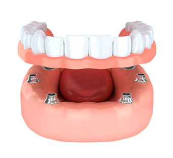 Протезирование зубов изображение 4