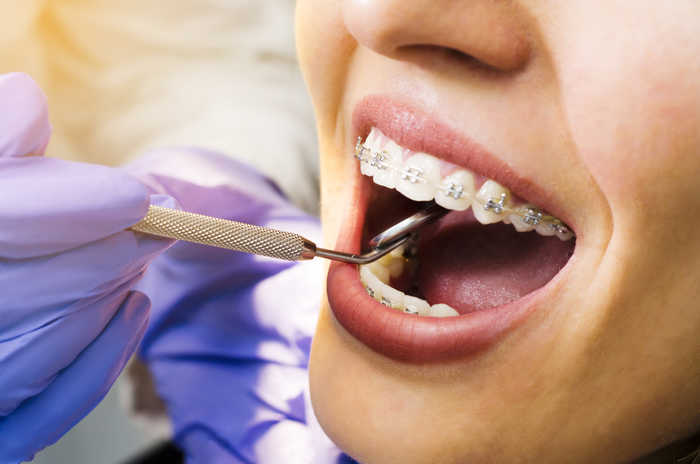 Вестибулярная брекет-система устанавливается на внешней поверхности зубного ряда