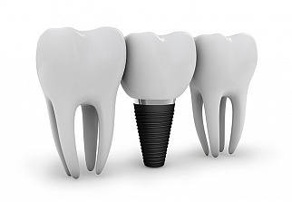 Преимущества, которые обеспечивают базальные зубные импланты