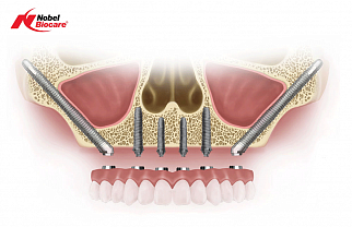 Что такое скуловая имплантация зубов: отзывы пациентов, особенности методики