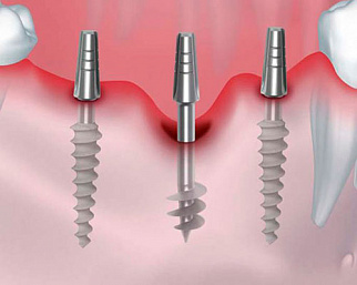 Базальная имплантация зубов: отзывы об особенностях протокола