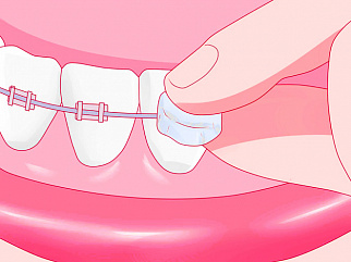 Ортодонтический воск для брекетов