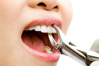 Удаление зубов в современной стоматологии