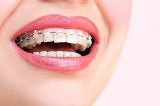 Кривые зубы: когда и как исправляют