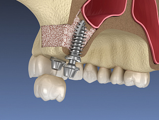 Наращивание зубной кости для имплантов