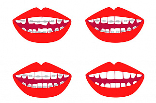 Особые рекомендации по уходу за зубами после снятия брекетов
